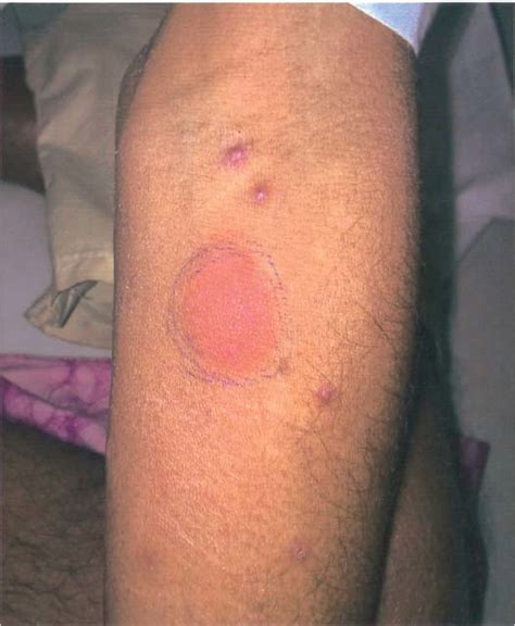 mt test positive images|Mantoux test .